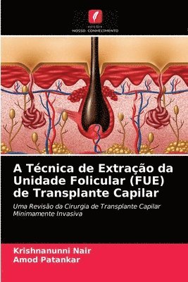 A Tcnica de Extrao da Unidade Folicular (FUE) de Transplante Capilar 1