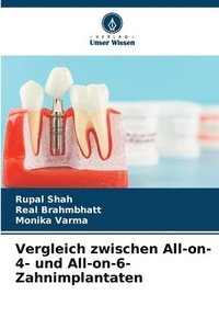 bokomslag Vergleich zwischen All-on-4- und All-on-6-Zahnimplantaten