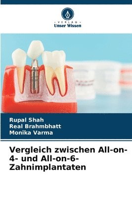 Rupal Shah, Real Brahmbhatt, Monika Varma, REAL BRAHMBHATT - Vergleich zwischen All-on-4- und All-on-6-Zahnimplantaten, Häftad