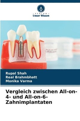 Vergleich zwischen All-on-4- und All-on-6-Zahnimplantaten 1