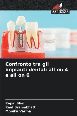 bokomslag Confronto tra gli impianti dentali all on 4 e all on 6