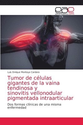 Tumor de clulas gigantes de la vaina tendinosa y sinovitis vellonodular pigmentada intraarticular 1