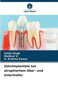 bokomslag Zahnimplantate bei atrophiertem Ober- und Unterkiefer