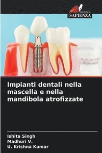 bokomslag Impianti dentali nella mascella e nella mandibola atrofizzate