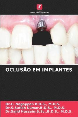 Ocluso Em Implantes 1