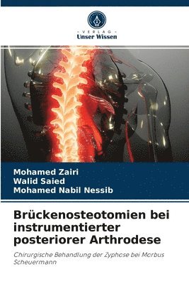Brckenosteotomien bei instrumentierter posteriorer Arthrodese 1