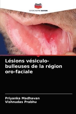 Lsions vsiculo-bulleuses de la rgion oro-faciale 1