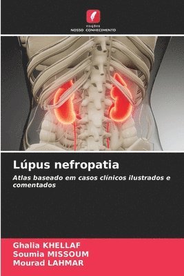 Lpus nefropatia 1