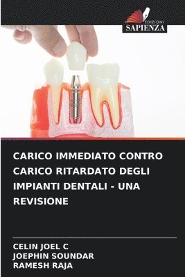 Carico Immediato Contro Carico Ritardato Degli Impianti Dentali - Una Revisione 1
