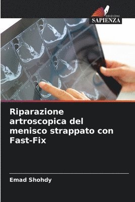 Riparazione artroscopica del menisco strappato con Fast-Fix 1