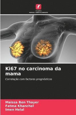 Ki67 no carcinoma da mama 1
