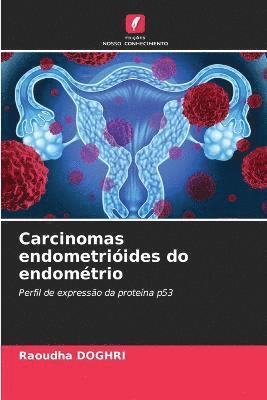 Carcinomas endometriides do endomtrio 1