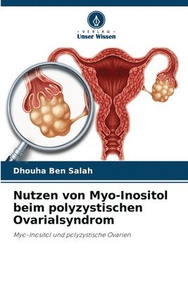 Nutzen von Myo-Inositol beim polyzystischen Ovarialsyndrom 1