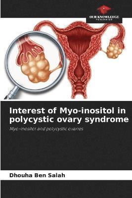 Interest of Myo-inositol in polycystic ovary syndrome 1