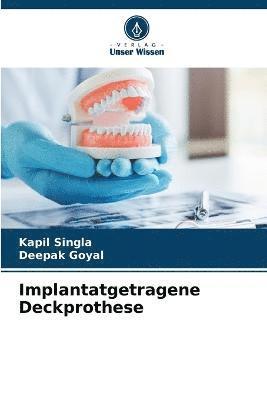 bokomslag Implantatgetragene Deckprothese