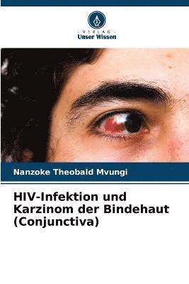 HIV-Infektion und Karzinom der Bindehaut (Conjunctiva) 1