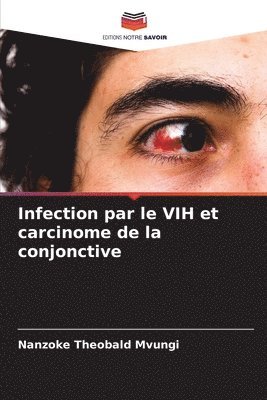 bokomslag Infection par le VIH et carcinome de la conjonctive