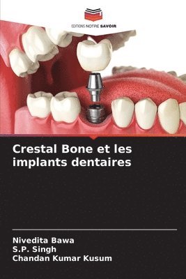 Crestal Bone et les implants dentaires 1