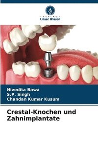 bokomslag Crestal-Knochen und Zahnimplantate