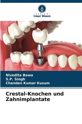 Crestal-Knochen und Zahnimplantate 1