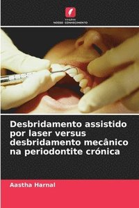 bokomslag Desbridamento assistido por laser versus desbridamento mecnico na periodontite crnica
