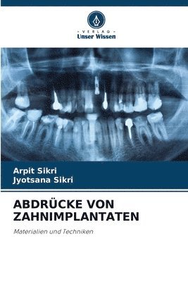Abdrcke Von Zahnimplantaten 1