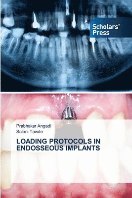 Loading Protocols in Endosseous Implants 1