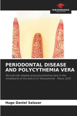 Periodontal Disease and Polycythemia Vera 1