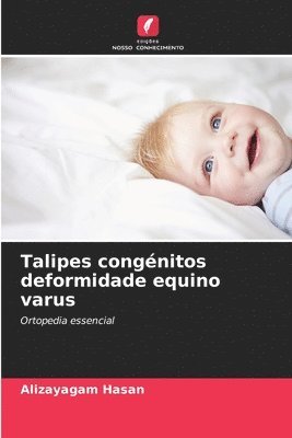 Alizayagam Hasan - Talipes congénitos deformidade equino varus, Häftad
