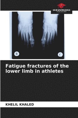 Fatigue fractures of the lower limb in athletes 1