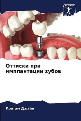 Притам Джайн, &#1 &#1044;&#1078;&#1072;&#1081;&#1085;, ¿¿¿¿¿¿ ¿¿¿¿¿ - Оттиски при имплантации зубов, Häftad
