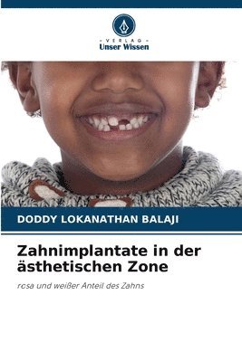 Zahnimplantate in der asthetischen Zone 1