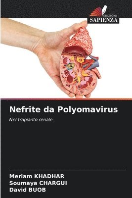 Nefrite da Polyomavirus 1