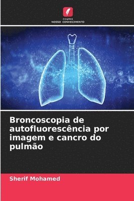 Broncoscopia de autofluorescncia por imagem e cancro do pulmo 1