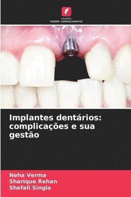 Implantes dentrios 1