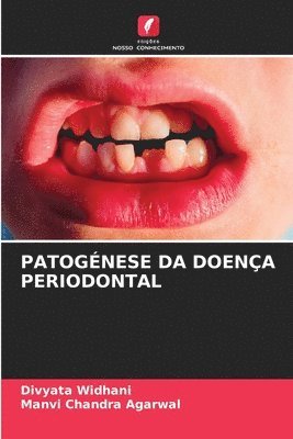 Patognese Da Doena Periodontal 1