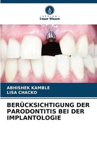 bokomslag Bercksichtigung Der Parodontitis Bei Der Implantologie