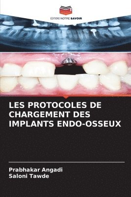 Les Protocoles de Chargement Des Implants Endo-Osseux 1