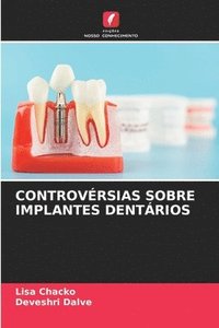 bokomslag Controvrsias Sobre Implantes Dentrios