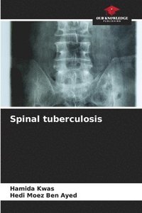 bokomslag Spinal tuberculosis