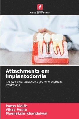 Attachments em implantodontia 1