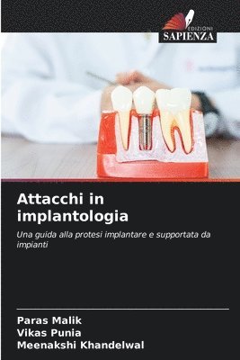 Attacchi in implantologia 1