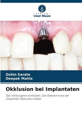 Okklusion bei Implantaten 1