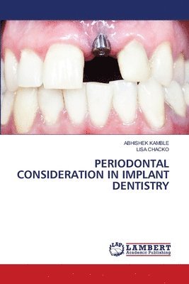 Periodontal Consideration in Implant Dentistry 1