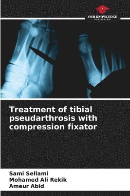 Treatment of tibial pseudarthrosis with compression fixator 1
