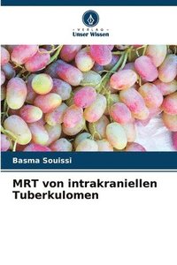 bokomslag MRT von intrakraniellen Tuberkulomen
