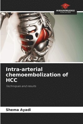 Intra-arterial chemoembolization of HCC 1