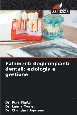 Fallimenti degli impianti dentali 1