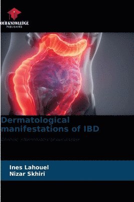 Dermatological manifestations of IBD 1