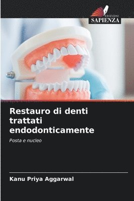 Restauro di denti trattati endodonticamente 1